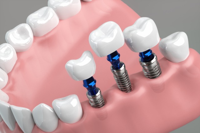ご自分の歯と同等の機能を取り戻す治療法です
